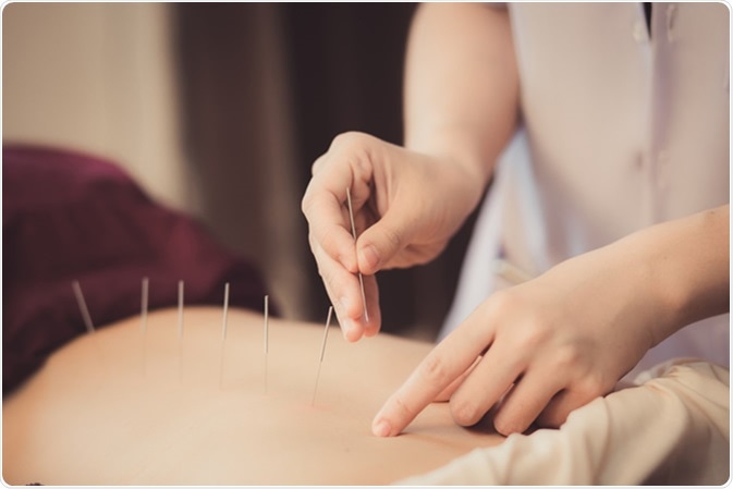 Acupuncture. Image Credit: NiP STUDIO / Shutterstock