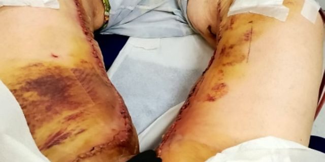 Jen Costa's legs after the operation.