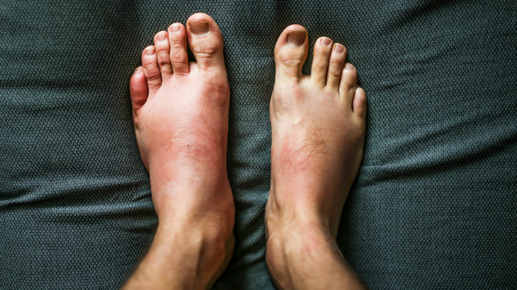 close up of feet showing swelling